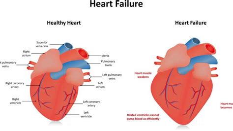 global hypokinesis of left ventricle